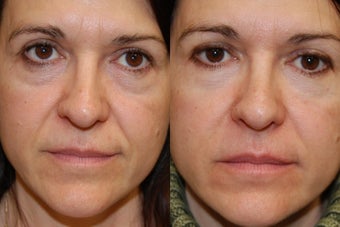 Non-Surgical Facial Rejuvenation with Silikon-1000