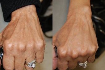 Hand Rejuvenation with Silikon-1000