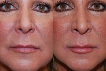 Silikon-1000 for Lip Augmentation and Marionette Grooves