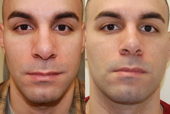 Lower Eyelid Rejuvenation with Silikon-1000