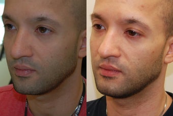Correction of a crooked Chin Implant with Silikon-1000