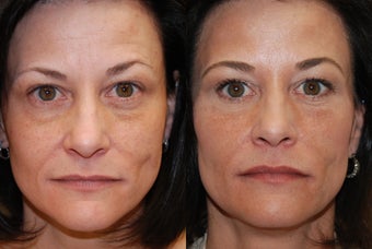 Non-surgical facial rejuvenation with Silikon-1000 and Botox.