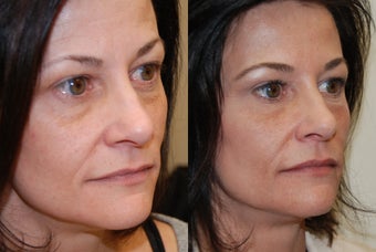 Non-Surgical Facial rejuvenation with Silikon-1000 and Botox.