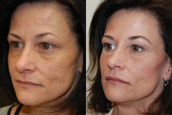Non-surgical facial rejuvenation with Silikon-1000 and Botox.