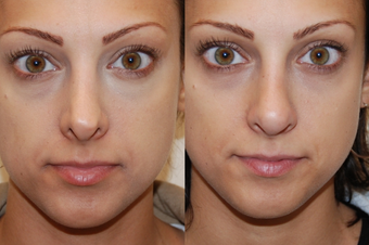 Non-Surgical Rhinoplasty with Silikon-1000