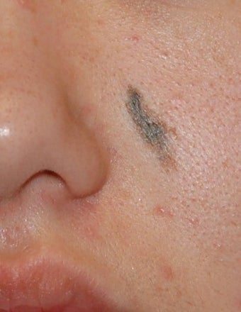 Lesion Removal, Excision