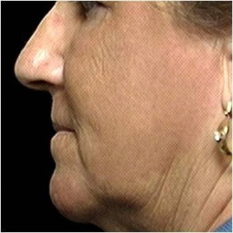 CO2 Laser Skin Resurfacing