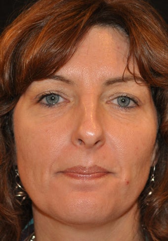 Obagi Nu Derm facial skin rejuvenation