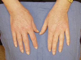Hand Rejuvenation with Radiesse