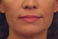 Laser Skin Tightening