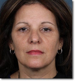 ZPL Peel Light Laser (Weekend Peel) Skin Rejuvenation