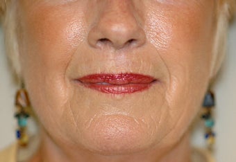 Before and Resurfacing Coblation Skin Resurfacing