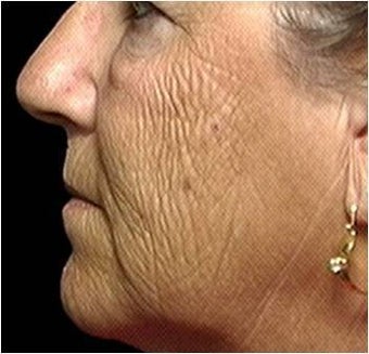 CO2 Laser Skin Resurfacing