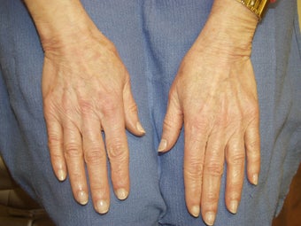 Hand Rejuvenation with Radiesse