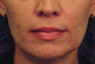Laser Skin Tightening