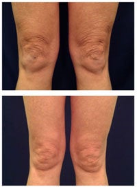 Laser Skin Tightening
