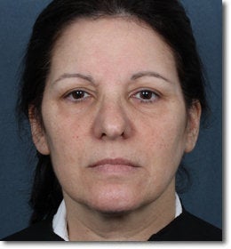 ZPL Peel Light Laser (Weekend Peel) Skin Rejuvenation