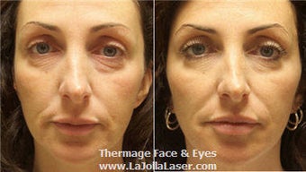 Thermage skin tightening for face and eyes