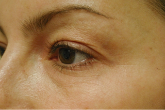 Laser eyelift