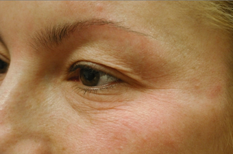 Laser eyelift