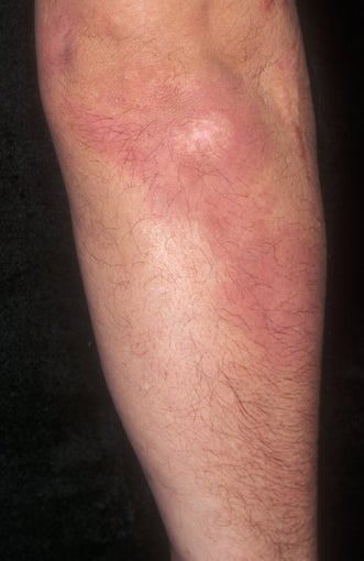 Psoriasis Treatment
