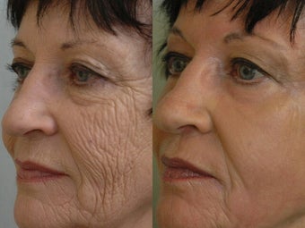 Deep Peel
