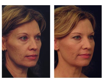 YAG Laser Skin Tightening