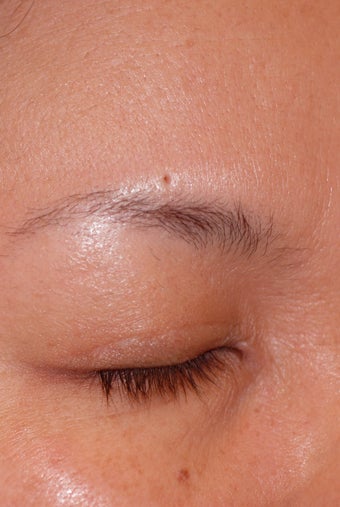 Skin Tag Removal Before Photo 