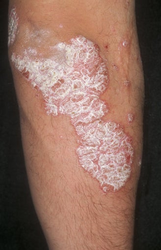 Psoriasis Treatment