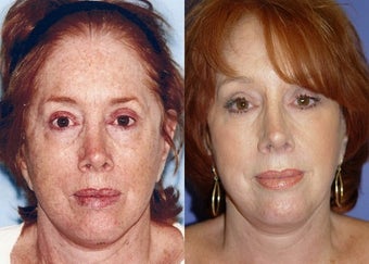 Skin Resurfacing