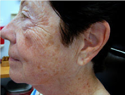Fractional laser therapy