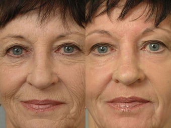 Deep Peel