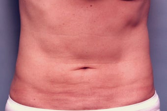 Slim Lipo