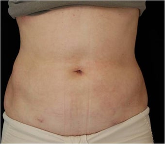 SlimLipo Abdomen Showing Skin Tightening