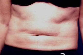 Slim Lipo