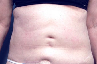 Slim Lipo