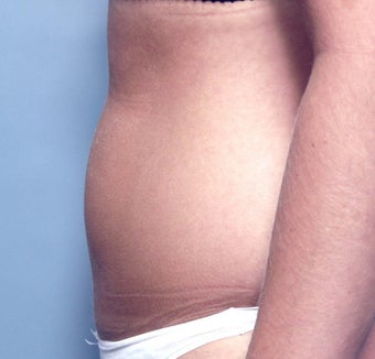 Slim Lipo