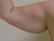 Slim Lipo on the arms