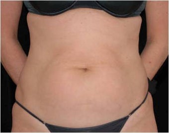 SlimLipo Abdomen Showing Skin Tightening