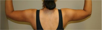 SmartLipo Arms Bilateral