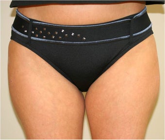 Smart Lipo Saddlebags (moderate)