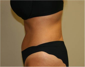 SmartLipo Love Handles, Lateral View