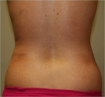 SmartLipo Love Handles Posterior View