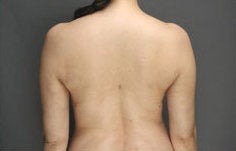 SmartLipo MPX of back and flanks