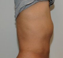 Smartlipo in Males