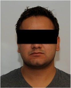 Smartlipo Neck