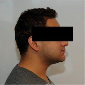 Smartlipo Neck