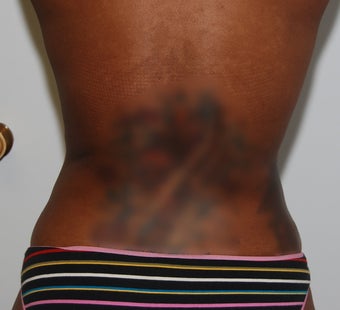 Smart Lipo