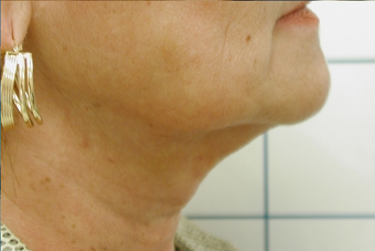 SmartLipo