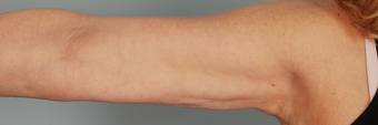 Smart Lipo